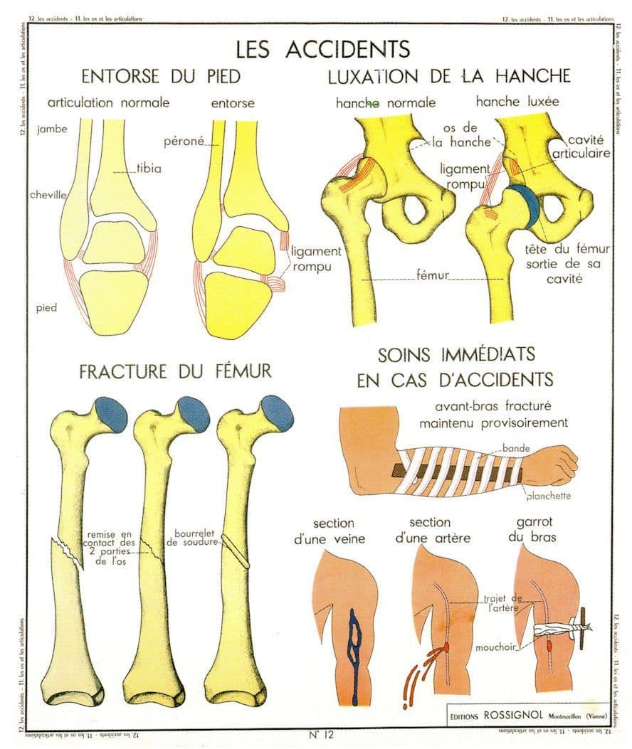 Femur Bones Accidents Disaster Arm Sling Old School Wall Chart Postcard